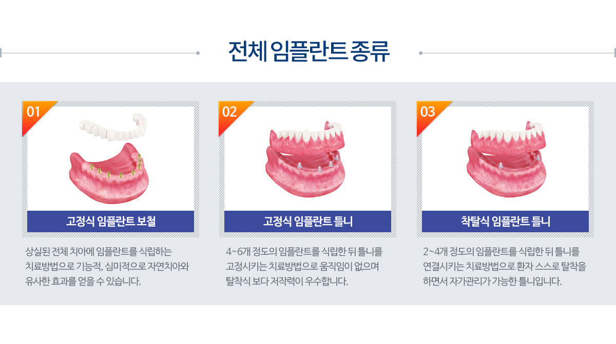 전체임플란트의 종류