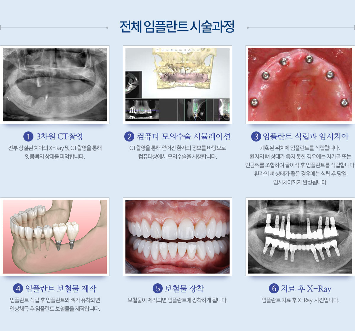 전체임플란트 시술과정