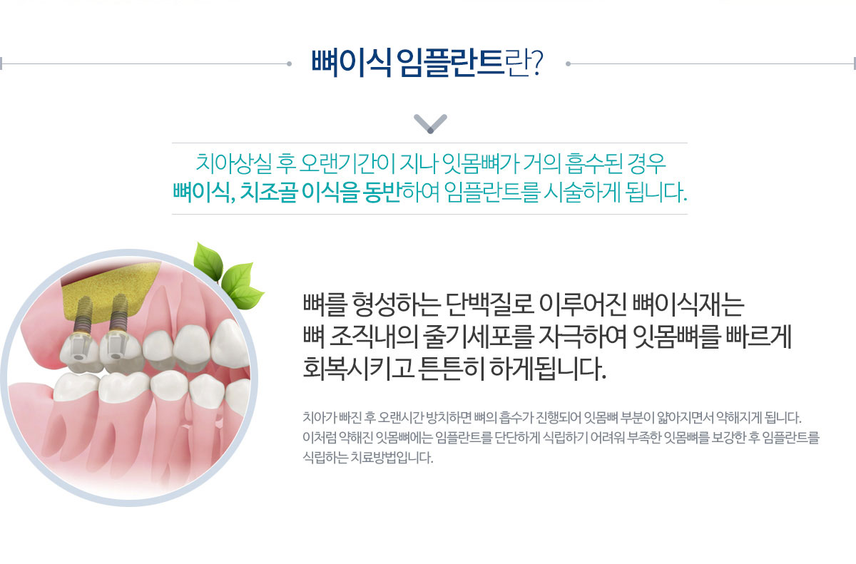 뼈이식임플란트란?