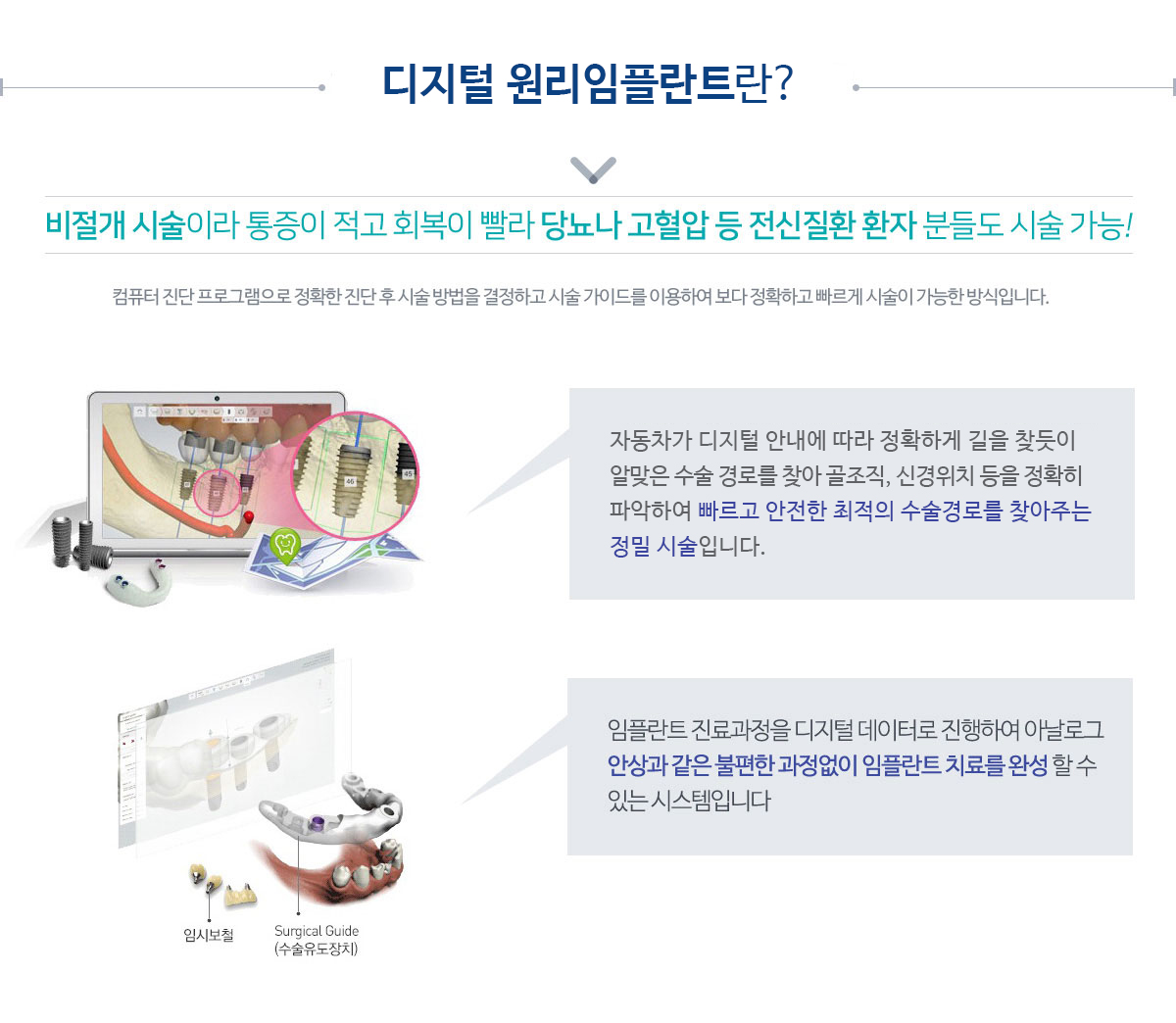 네비게이션 원리 임플란트란?