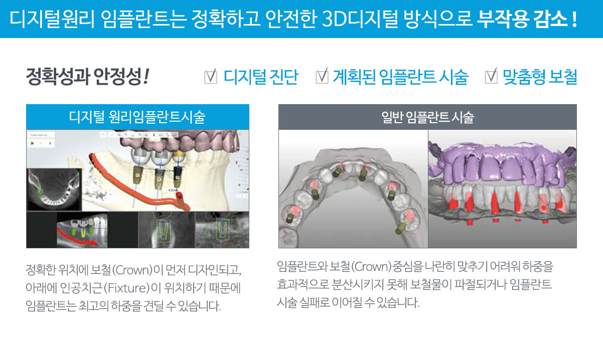 네비게이션 원리 임플란트는 정확하고 안전한 3D 디지털 방식으로 부작용 최소화!