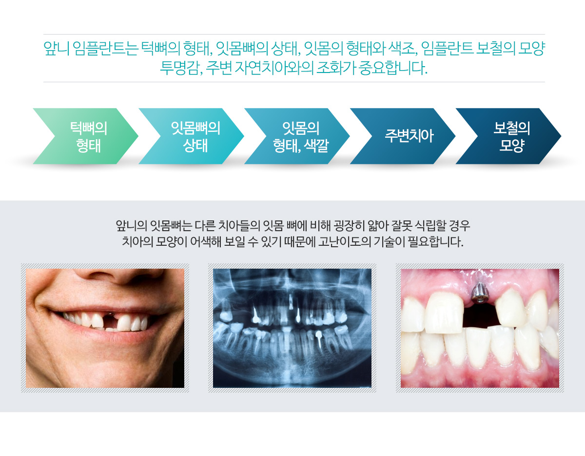앞니 임플란트 치료대상