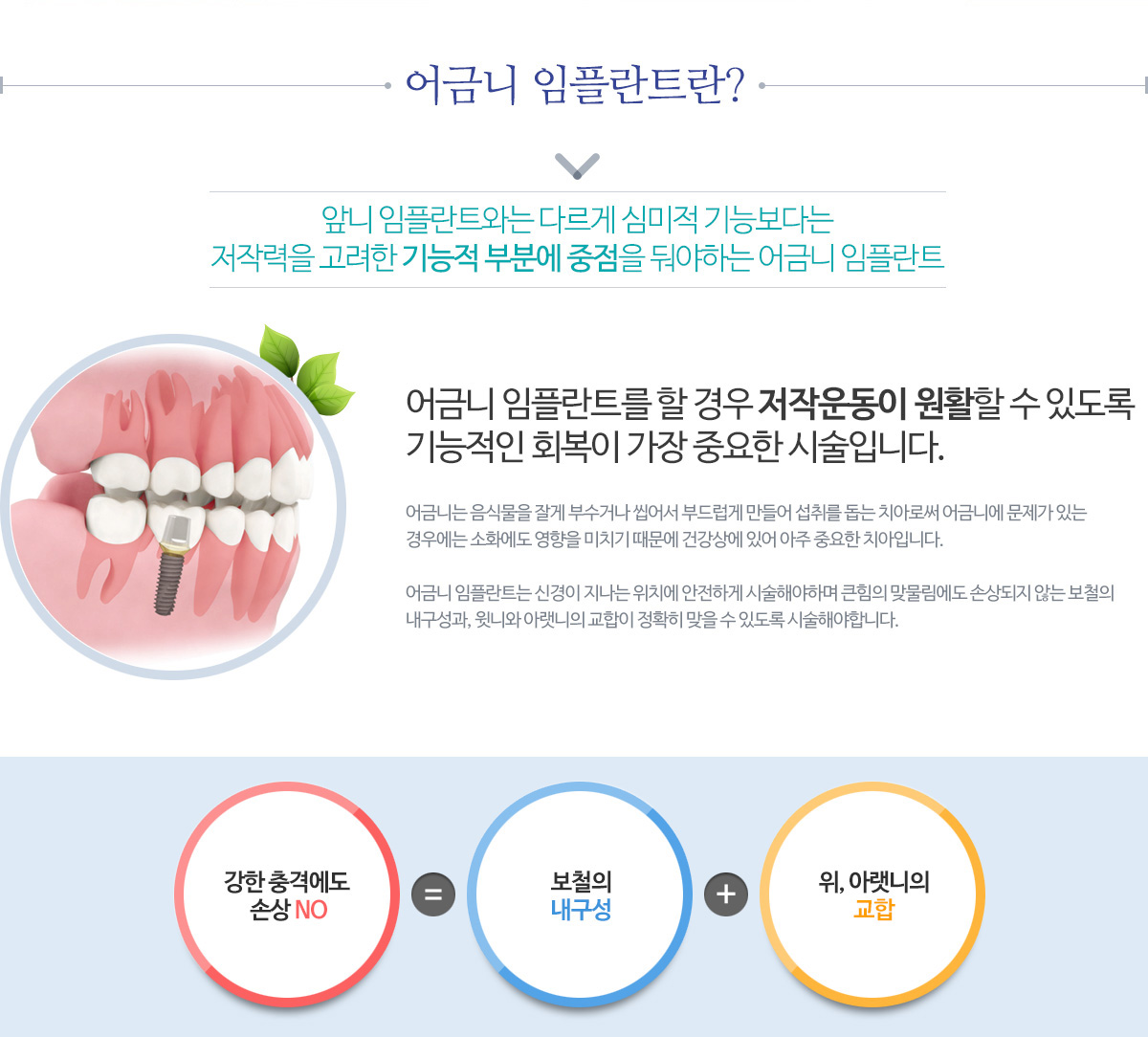 어금니임플란트란?