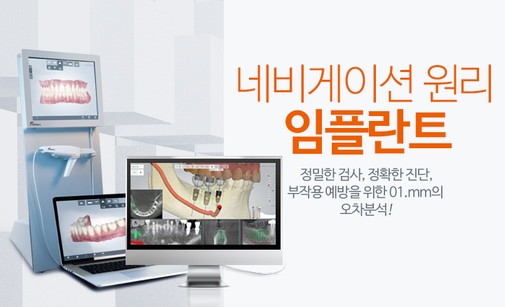 임플란트
