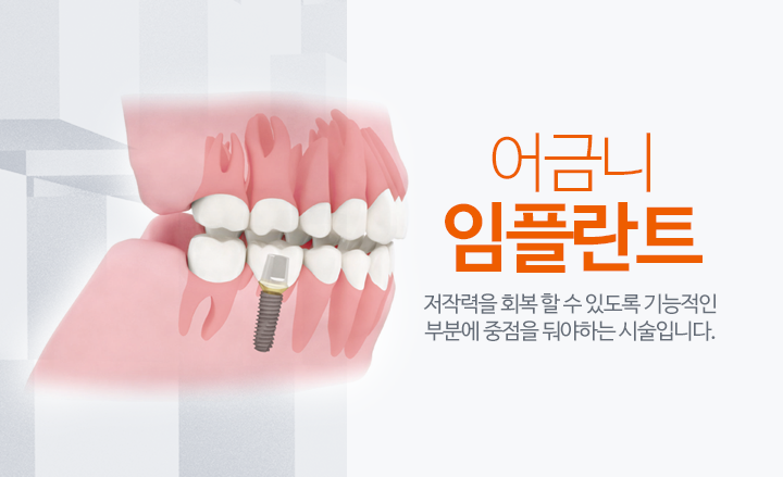 임플란트