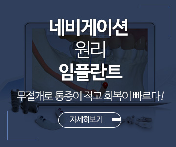네비게이션 원리 임플란트