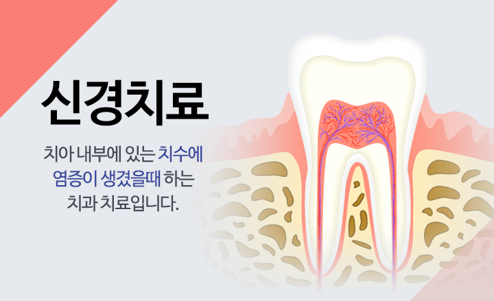 신경치료